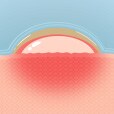 Blister Bandage Pad Infographic
